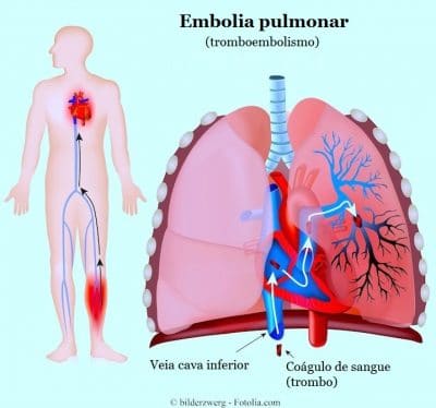 Resultado de imagem para embolia pulmonar raio x