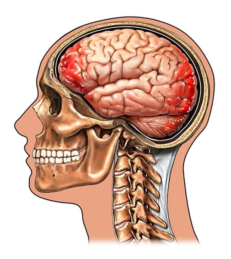 Hemorragia Cerebral Sintomas Tipos Intraparenquimatosa Consequ Ncias