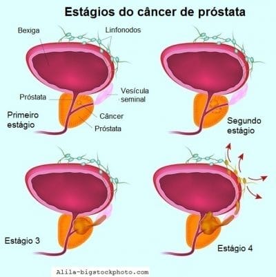 Resultado de imagem para câncer de próstata