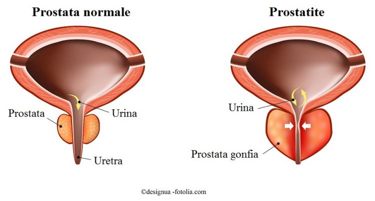 próstata inflamada