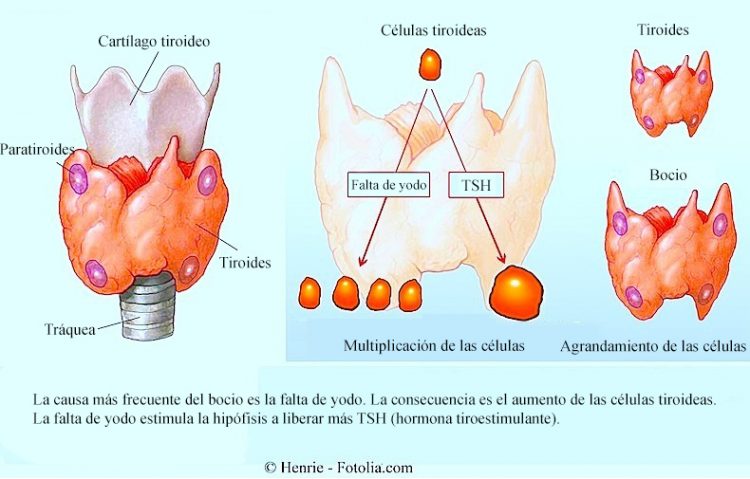 tiroides, bocio, TSH