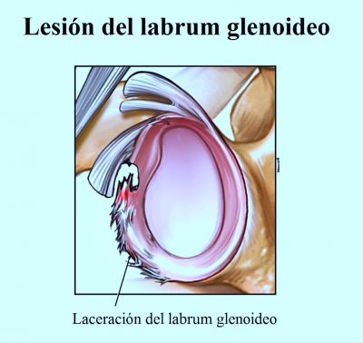 lesión del labbro glenoideo