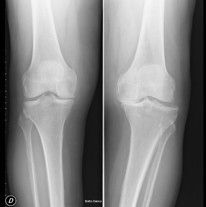 Radiografia, os joelhos, artrose, alinhamento incorreto, cartilagem, consumido, desgastado