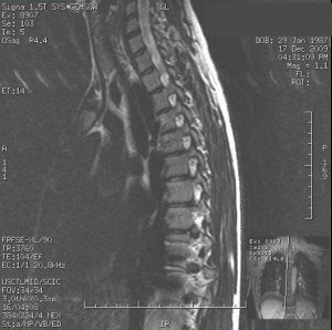 RMN , espinha dorsal, lombar, músculo, nervo, neuropatia periférica, doença do disco, hérnia de disco, protrusão, abaulamento, coluna, coluna vertebral, raiz nervosa, o anel fibroso, núcleo pulposo, D1, D2, D3, D4, D5, D6, D7, D8