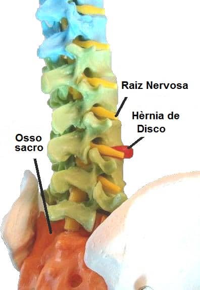 Tratamento para a artrose da coluna vertebral