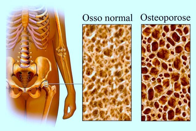 osteoporose,quadril
