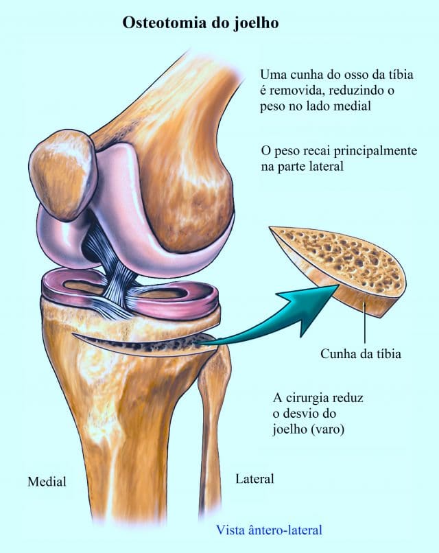  osteotomia,do,joelho