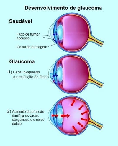 Glaucoma no olho sintomas, causas, tratamento, cirurgia e tipos
