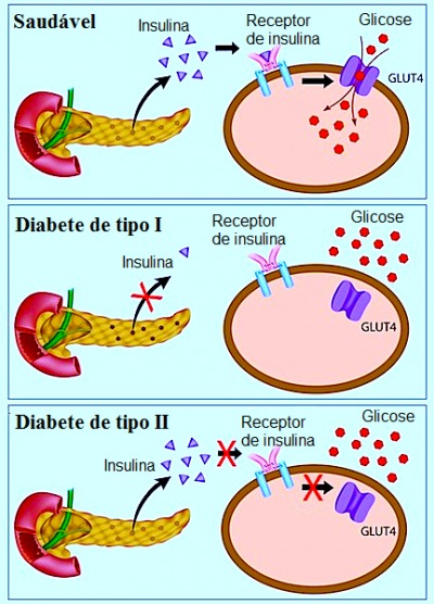 Sintomas da diabetes