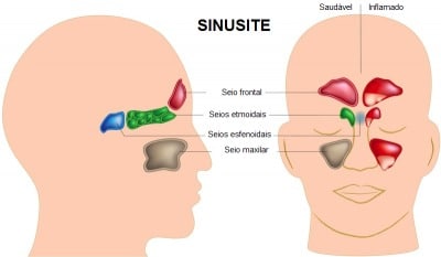 Sintomas da sinusite