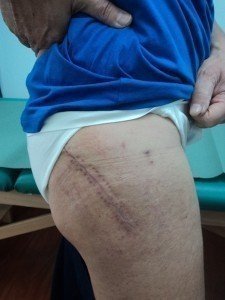 cicatriz do intervento da pròtese do quadril 