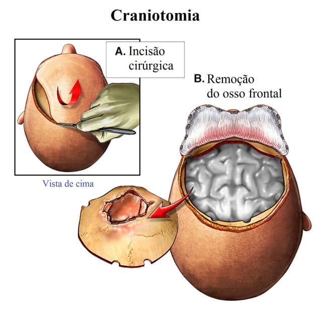 craniotomia