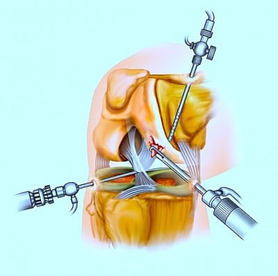 cirurgia do joelho,artroscopia