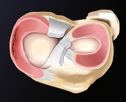 Lesão de menisco circonferencial