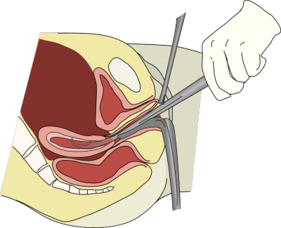 Curetagem uterina