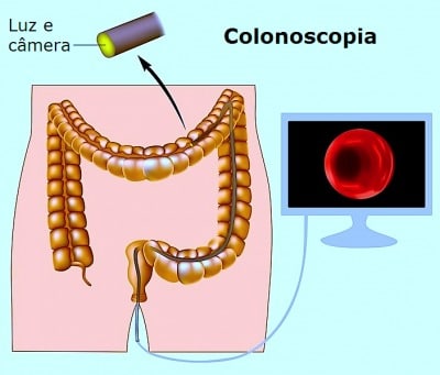 Exame de colonoscopia