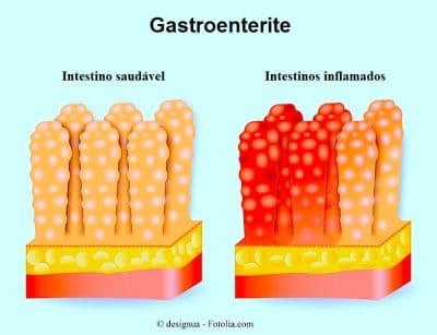 Gastroenterite ou gripe intestinal