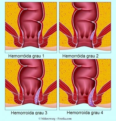 Hemorróidas externas e internas