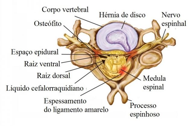 Hérnia,cervical,mediana,posterior
