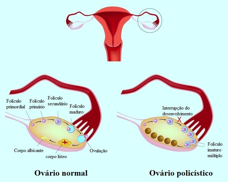 Quitar un ovario consecuencias