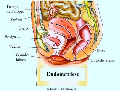Sintomas da endometriose