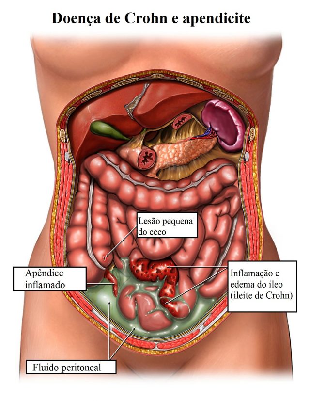 apendicite,e,doença,de,crohn
