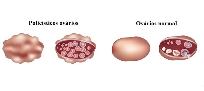 Síndrome do ovário policístico,diagnóstico diferencial,tumor,ovário
