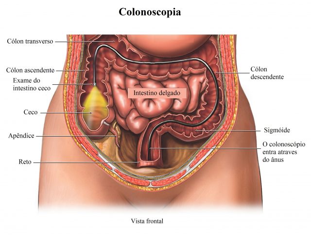  colonoscopia,intestino,cólon