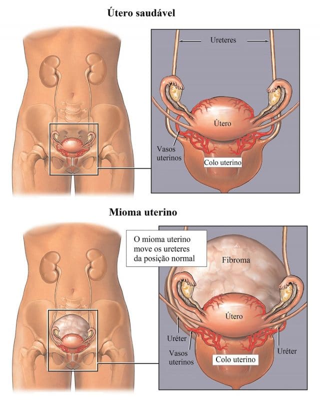 fibroma,uterino
