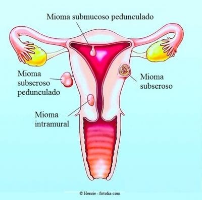 mioma uterino, submucoso, Subseroso, intramural 