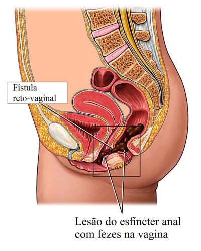 fístula,reto,vaginal