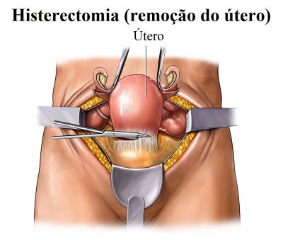 histerectomia,remoção,útero