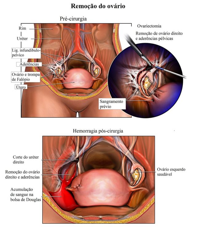 remoção,de,ovário,ooforectomia