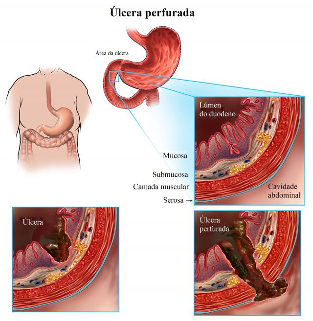 úlcera,duodenal,estômago