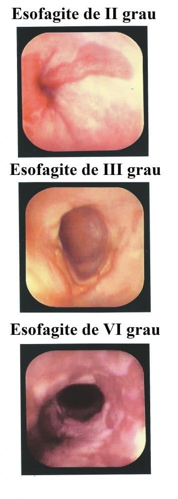 Esofagite-de-II-III-IV-grau