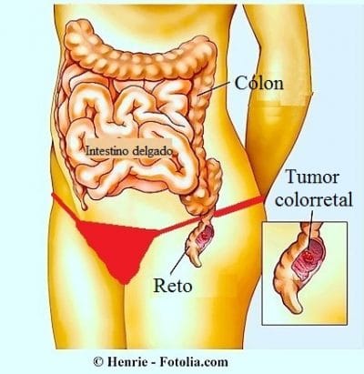 Sintomas da obstrução intestinal