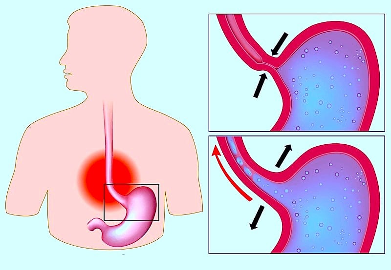 Esofagite de refluxo gastroesofágico, esfíncter fechado