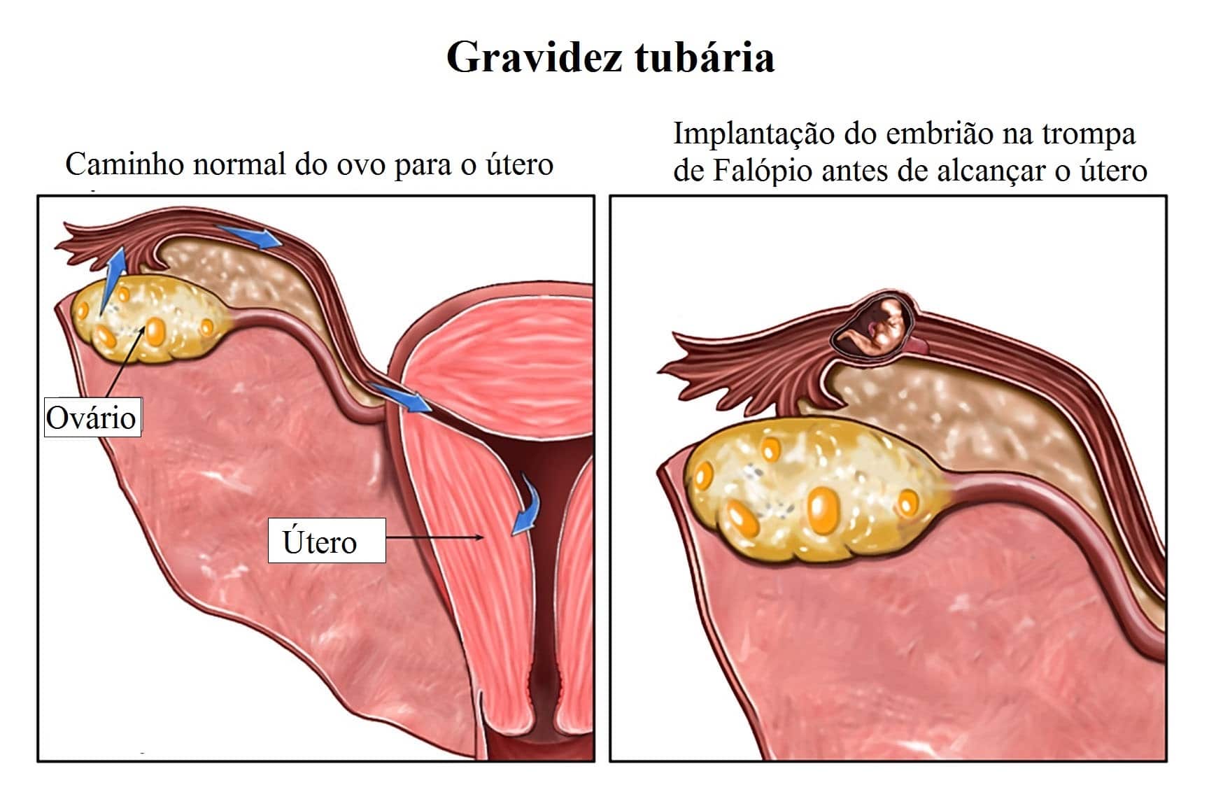 Implantacion del ovulo