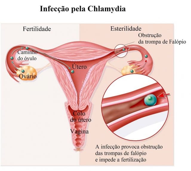 infertilidade,esterilidade