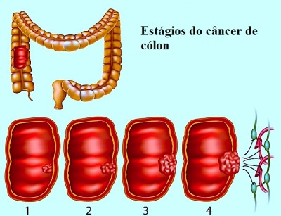 Cancer de colon vertebral - Negi genitale transmise femeii
