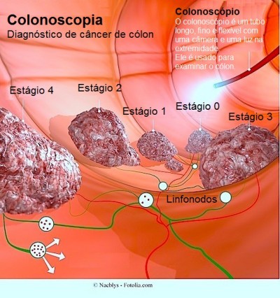Câncer de cólon,Estágios,metástases,gânglios linfáticos,linfonodos