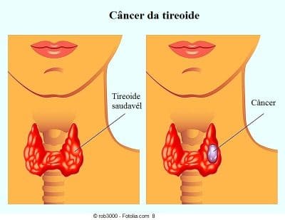 Câncer de tireoide