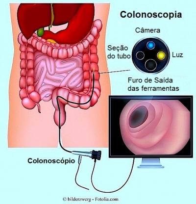 Colonoscopia, câncer de cólon