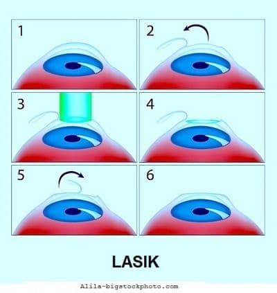 Laser nos olhos