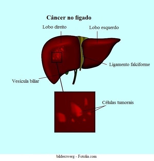 tumor benigno,no fígado, massa, hemangioma, sintomas, tratamento