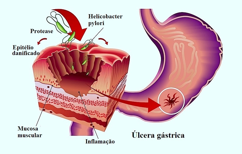 Úlcera gástrica, Helicobacter pylori, inflamação do estômago