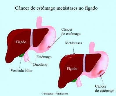 metástases hepáticas,no figado,câncer de estômago