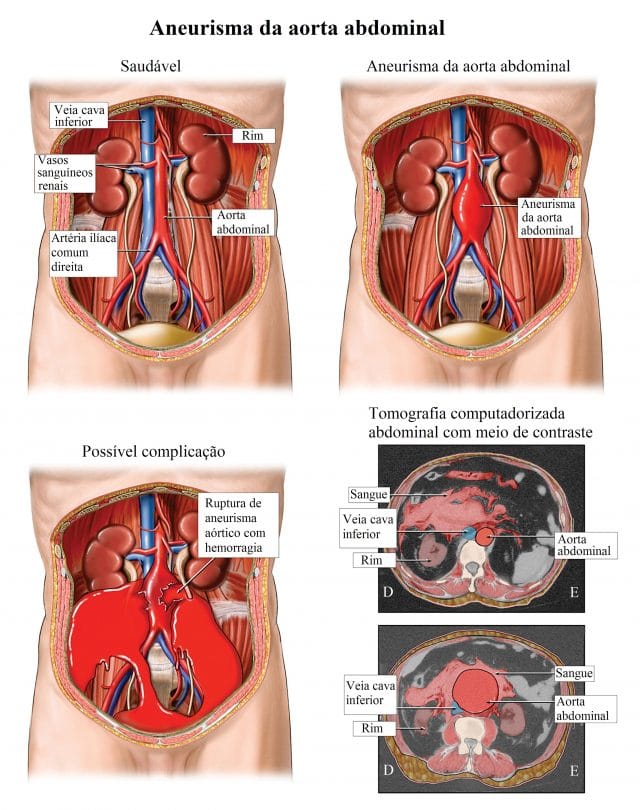 aneurisma,aorta,abdominal