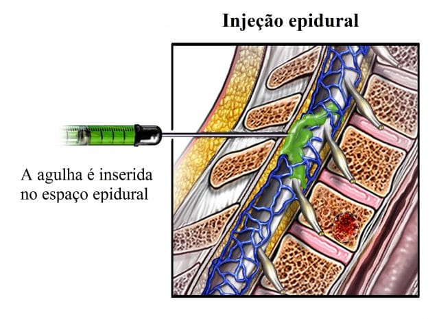  injeção,epidural,cervical