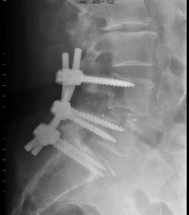 Radiografia da coluna lombar,Artrodese